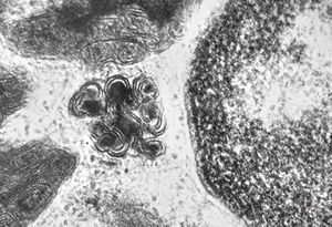 M,3y. | mast cell - granules with scroll-like formations - n. suralis, Krabbe globoid leukodystrophy M,3y. | mast cell - granules with scroll-like formations - n. suralis, Krabbe globoid leukodystrophy